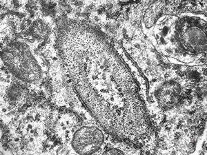 M,41y. | hairy cell leukemia - spleen - ribosome-lamella complex in tricholeukocyte M,41y. | hairy cell leukemia - spleen - ribosome-lamella complex in tricholeukocyte